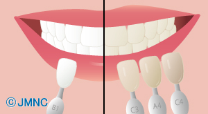 歯のエステ／ホワイトニング治療
