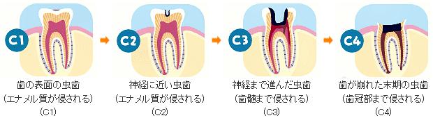 C1 歯の表面の虫歯（エナメル質が侵される）C2神経に近い虫歯（エナメル質が侵される）C3神経まで進んだ虫歯（骨髄まで侵される）C4歯が崩れた末期の虫歯（歯冠部まで侵される）