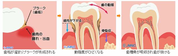 歯周病の進行と治療について 歯垢が溜まりプラークが形成される　動揺度がひどくなる　歯槽骨が吸収され歯が抜ける